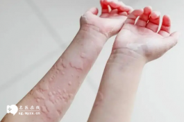 蕁麻疹不要直接做試管嬰兒，影響胚胎移植成功率是原因之一